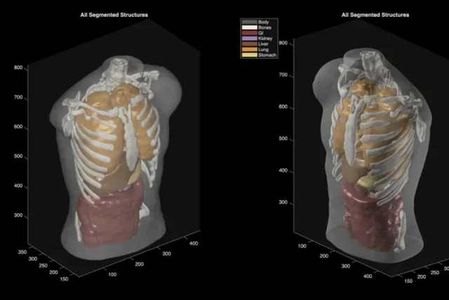 AI-Powered Ultrasound Tomography
